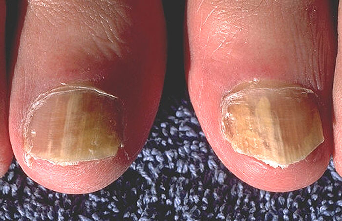Onicomicosis